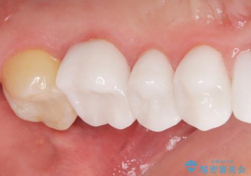 歯並びをきれいにしたい、歯を真っ白にしたい 40代男性の治療後