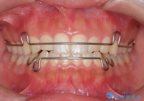 マウスピース矯正 下顎前歯のがたつきの改善の治療後