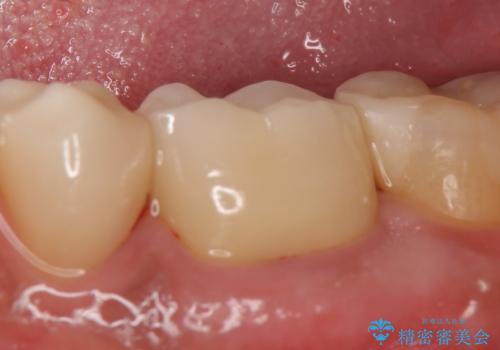 オールセラミッククラウン 銀歯を白くの治療後