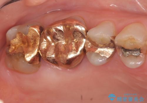 オールセラミッククラウン・セラミックインレー　歯茎より深い虫歯の治療の症例 治療前