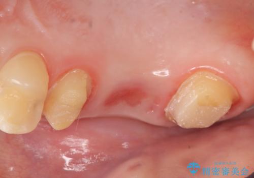 オールセラミッククラウン 奥歯のブリッジの治療中