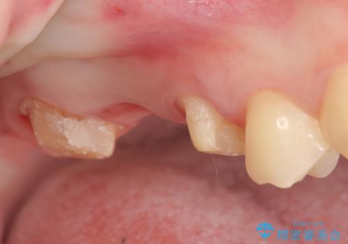 オールセラミッククラウン 奥歯のブリッジの治療中