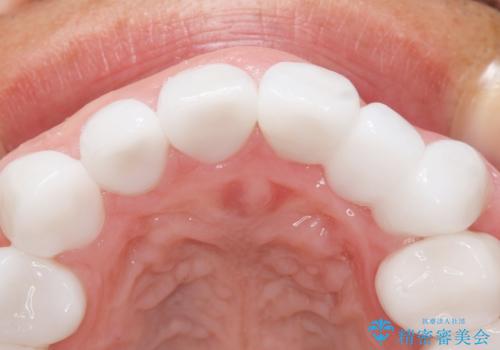 歯並びをきれいにしたい、歯を真っ白にしたい 40代男性の治療後