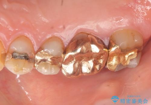 オールセラミッククラウン・セラミックインレー 歯茎より深い虫歯の治療の治療前