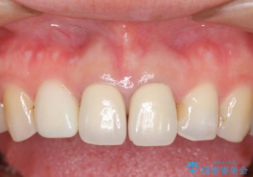 オールセラミッククラウン　前歯の劣化した古い樹脂をセラミックにの治療前