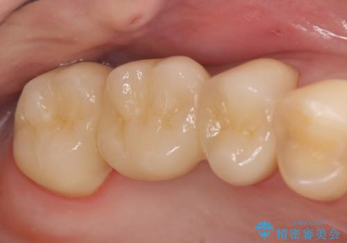オールセラミッククラウン 奥歯のブリッジの症例 治療後