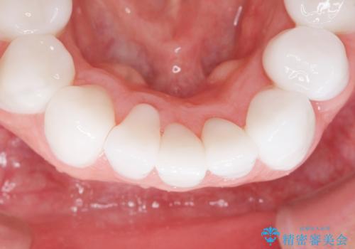 歯並びをきれいにしたい、歯を真っ白にしたい 40代男性の治療後