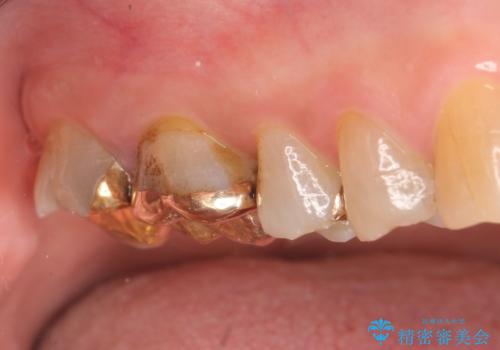 オールセラミッククラウン・セラミックインレー 歯茎より深い虫歯の治療の治療前