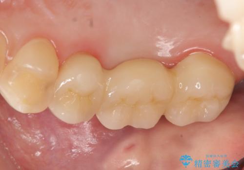 オールセラミッククラウン 奥歯のブリッジの治療後