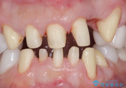 歯並びをきれいにしたい、歯を真っ白にしたい 40代男性の治療中