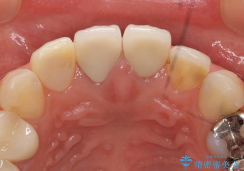 オールセラミッククラウン　前歯の劣化した古い樹脂をセラミックにの治療前