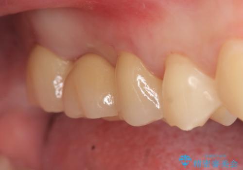 オールセラミッククラウン 奥歯のブリッジの治療後