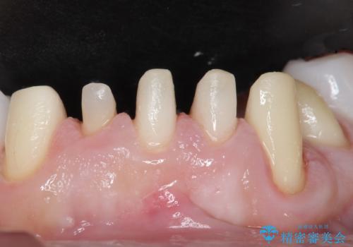 歯並びをきれいにしたい、歯を真っ白にしたい 40代男性の治療中