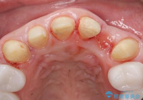 歯並びをきれいにしたい、歯を真っ白にしたい 40代男性の治療中