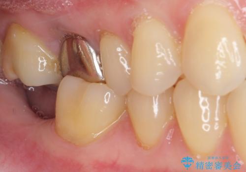 抜歯されたままの奥歯 ストローマンインプラントによる欠損補綴治療の治療前