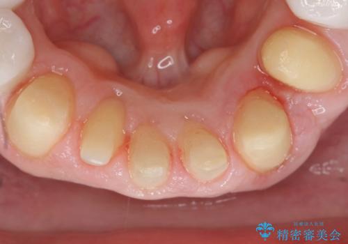 歯並びをきれいにしたい、歯を真っ白にしたい 40代男性の治療中