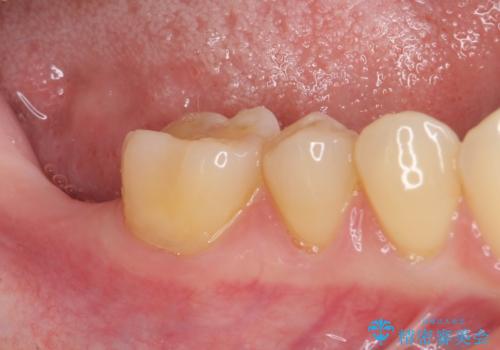 抜歯されたままの奥歯 ストローマンインプラントによる欠損補綴治療の治療前