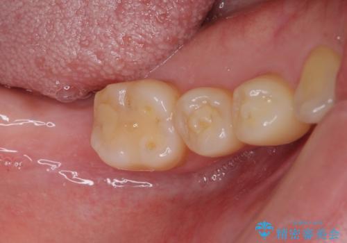 抜歯されたままの奥歯　ストローマンインプラントによる欠損補綴治療の症例 治療前
