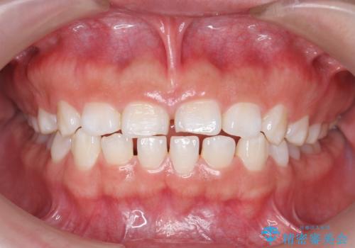 インビザライン　気になるすきっ歯の改善の症例 治療前