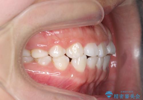 インビザライン 気になるすきっ歯の改善の治療前