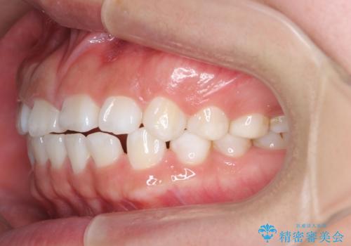 インビザライン 気になるすきっ歯の改善の治療前