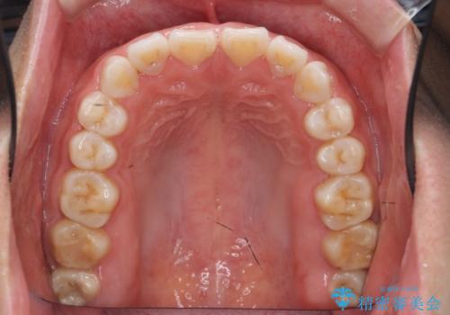 インビザライン 気になるすきっ歯の改善の治療前