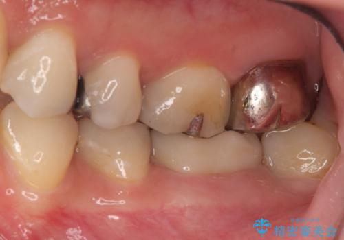 目立つ銀歯を白くしたい セラミック治療の治療後