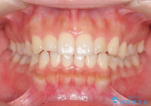 マウスピース矯正 下顎前歯のがたつきの改善の治療中