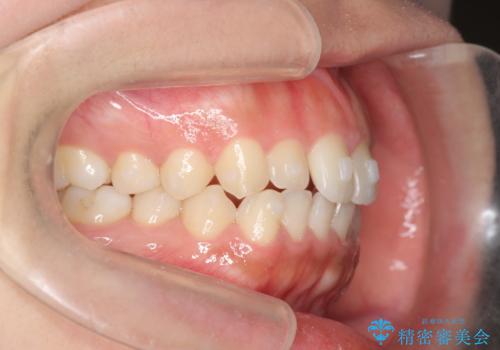 マウスピース矯正 下顎前歯のがたつきの改善の治療中