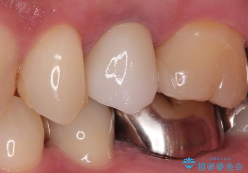 根管治療からのセラミック治療の症例 治療後