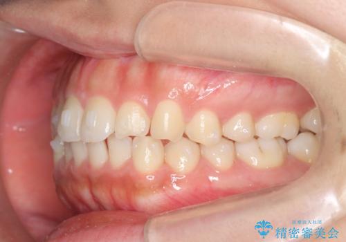 マウスピース矯正 下顎前歯のがたつきの改善の治療中