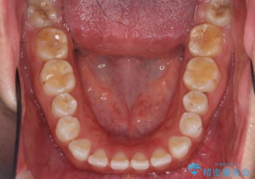 インビザライン　気になるすきっ歯の改善の治療前