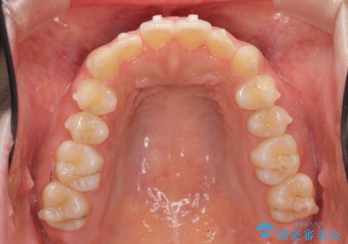 マウスピース矯正 下顎前歯のがたつきの改善の治療中
