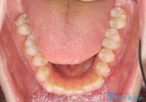 マウスピース矯正　下顎前歯のがたつきの改善の治療中