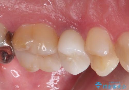 根管治療からのセラミック治療の治療後