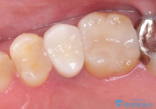 根管治療からのセラミック治療の治療後
