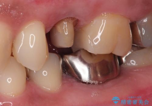 根管治療からのセラミック治療の治療中