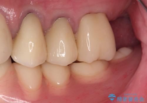 奥歯がなくてかめない 入れ歯とクラウンでの全顎治療の治療後