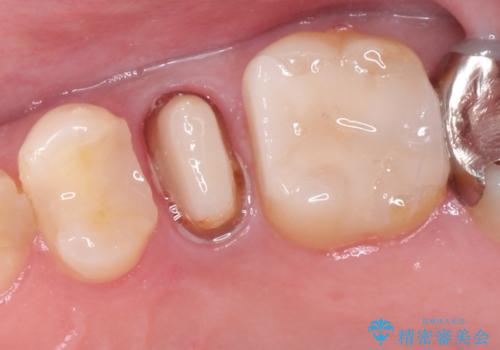 根管治療からのセラミック治療の治療中