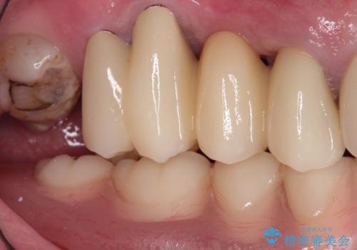 奥歯がなくてかめない 入れ歯とクラウンでの全顎治療の治療後