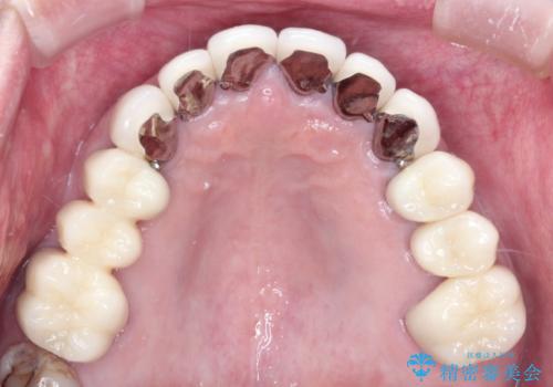 奥歯がなくてかめない 入れ歯とクラウンでの全顎治療の治療後