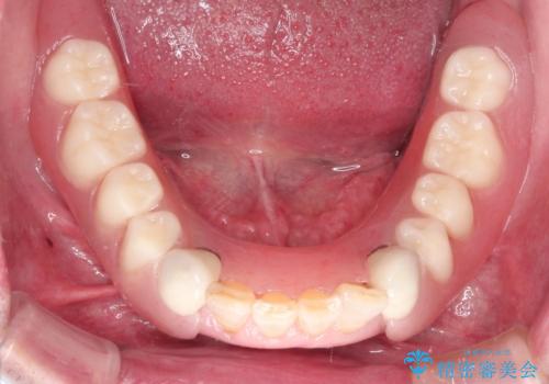 奥歯がなくてかめない 入れ歯とクラウンでの全顎治療の治療後