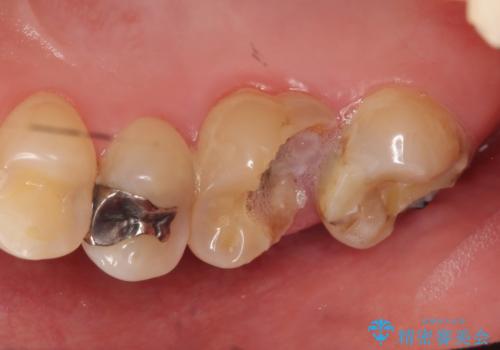 オールセラミッククラウン 奥歯のブリッジの治療前