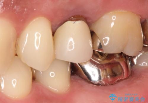 根管治療からのセラミック治療の症例 治療前