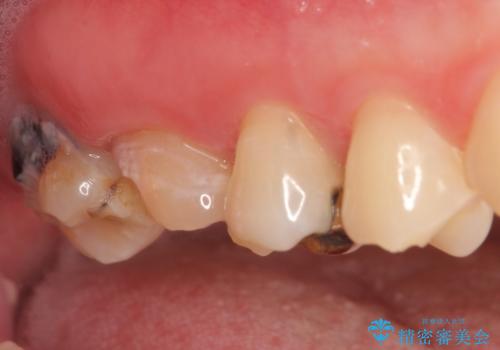 オールセラミッククラウン 奥歯のブリッジの治療前