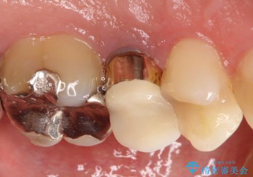 根管治療からのセラミック治療の治療前