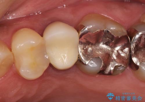根管治療からのセラミック治療の治療前