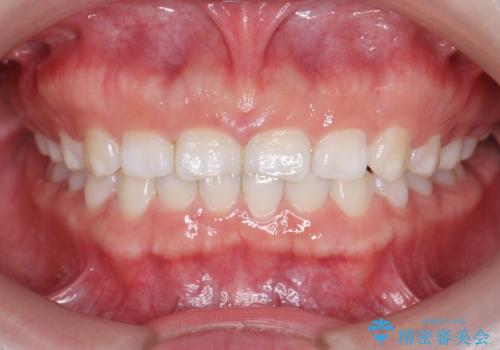 インビザライン　気になるすきっ歯の改善の症例 治療後