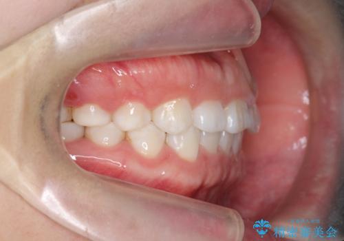 インビザライン 気になるすきっ歯の改善の治療後