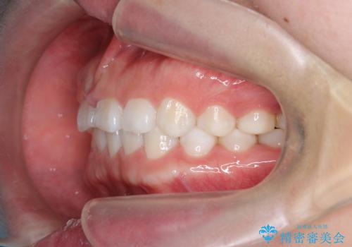 インビザライン 気になるすきっ歯の改善の治療後